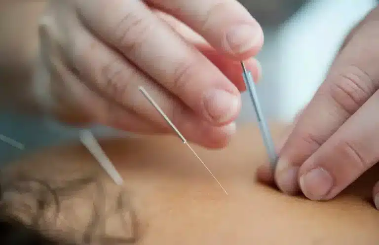 Similapunktur